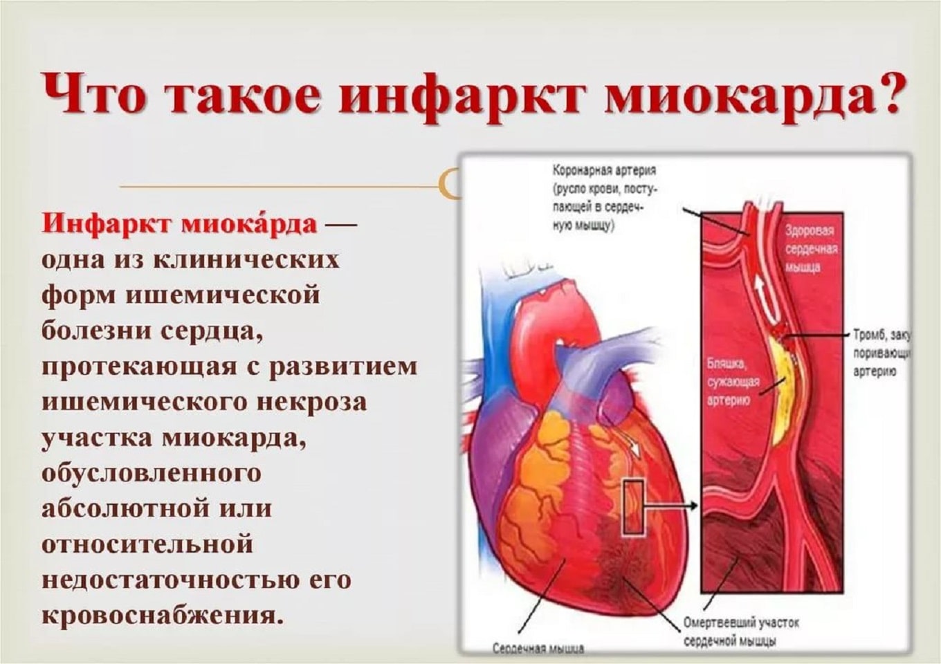 Инфаркт миокарда бляшка
